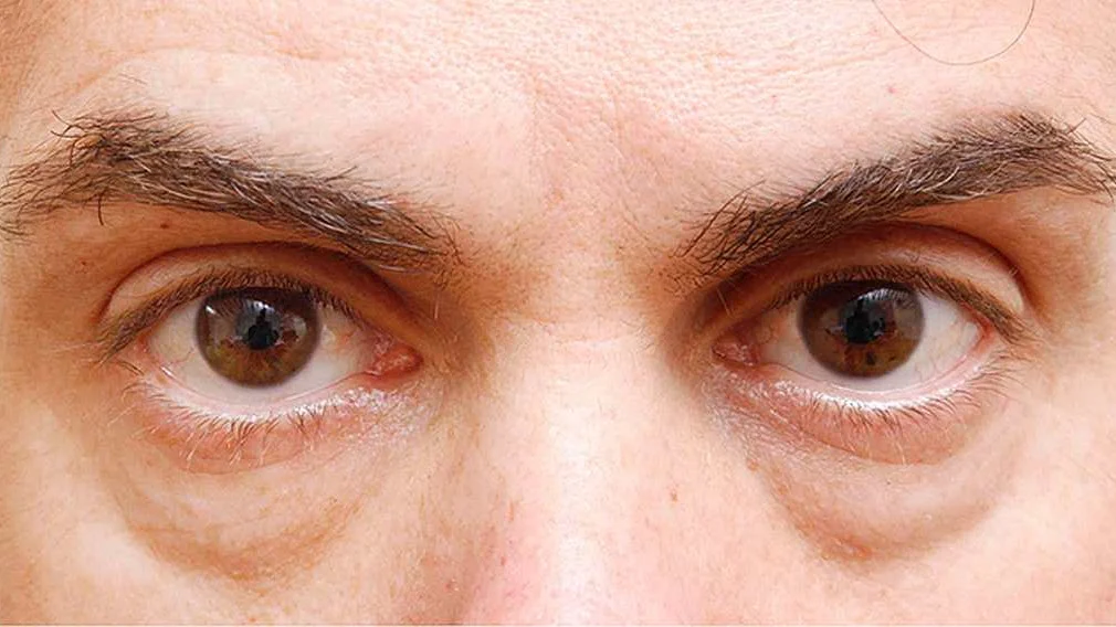 Read more about the article Cómo eliminar las ojeras de forma natural: Guía completa y efectiva